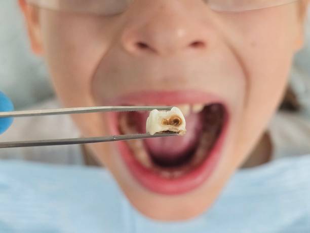 Best Lost Filling or Crown Replacement in Ttapoisett Center, MA